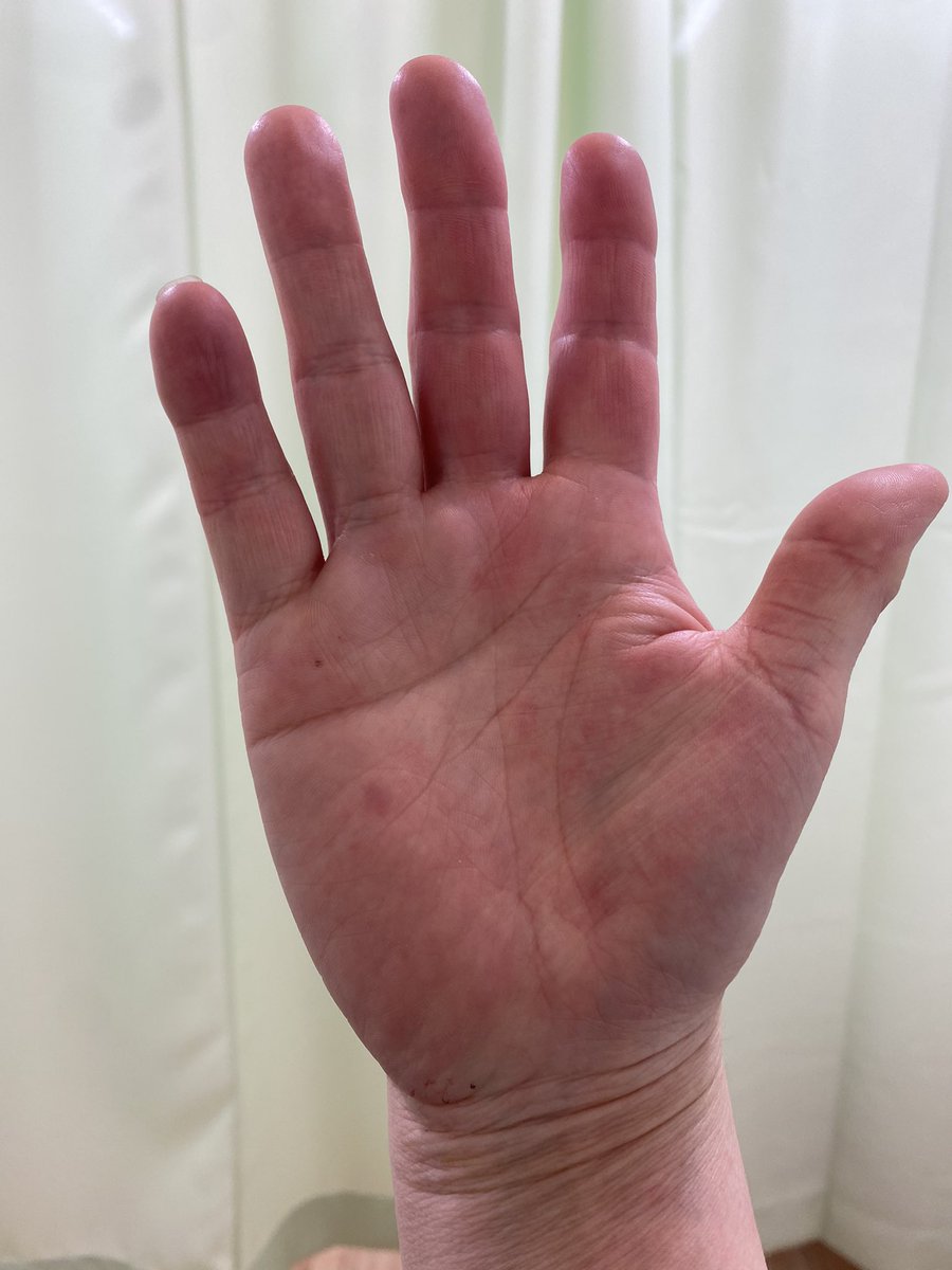 Haischlib ヘパーデン結節 Ar Twitter