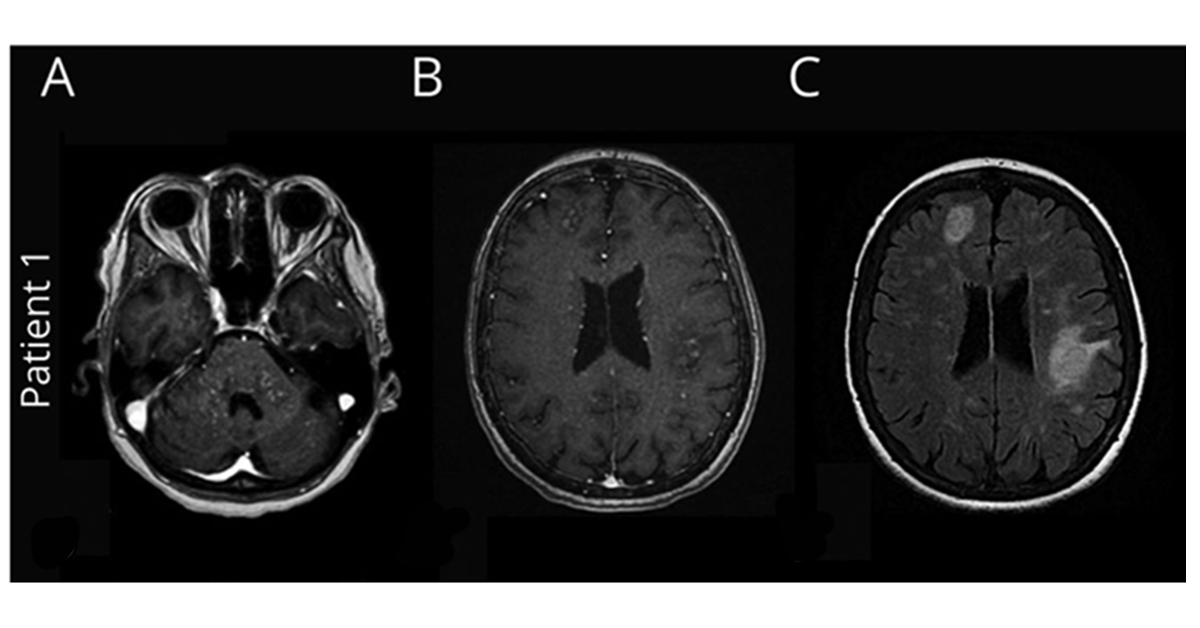 Neurology Journal On Twitter Hemophagocytic Lymphohistiocytosis Gene Mutations In Adult Patients Presenting With Clippers Like Syndrome Https T Co Mm0vkxuoki Neurology Https T Co 1y58r5so8s Twitter