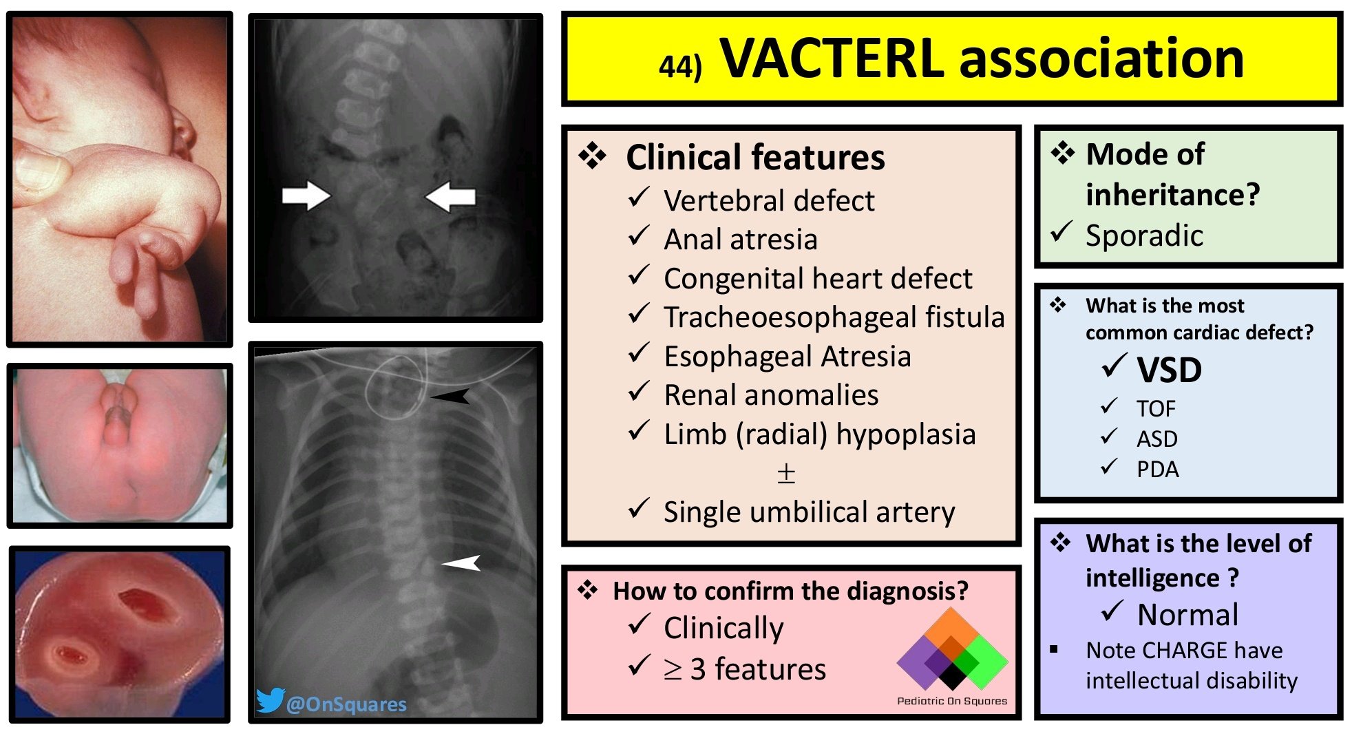 VATER Syndrome: Symptoms, Causes Treatment, 49% OFF