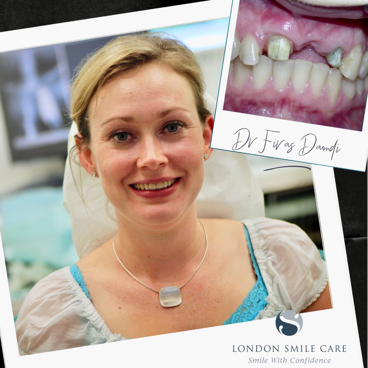 LondonSmileCare's tweet photo. #dentaltrauma at young age can lead to #rootcanaltreatment &amp; #toothloss 
For some #dentalbridge can replace the #missingtooth for a number of years. After (in this patient case) the best option was #dentalimplant with #bonegraft and cosmetic individual #porcelaincrowns https://t.co/rYQhFv60EU