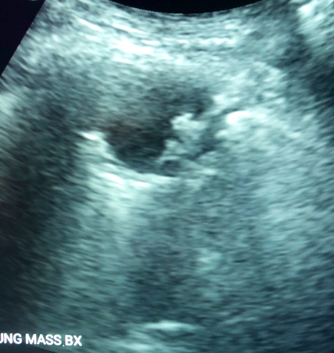 Lobulated L lung mass on CT in 60 yo F hx R NSCLC, but US is optimal for safe, effective real time imaging during biopsy #iRad #MedTwitter #oncology #FOAMrad <a href="/AIUMultrasound/">AIUM Ultrasound</a> <a href="/SIR_ECS/">SIR ECS</a> @Doc_Rock2 <a href="/drochohan/">Omar Chohan, DO</a> <a href="/RadsDanMD/">Dan Cohen MD</a> <a href="/Radiopaedia/">Radiopaedia.org</a> <a href="/RitchaSaxena/">Ritcha Saxena, MD</a> <a href="/ifechiukehMD/">Ifechi N. Ukeh, MD</a> <a href="/keithppereira/">Keith Pereira MD, #VIrad</a> <a href="/malvc/">Marco Leyva VC 😷</a>