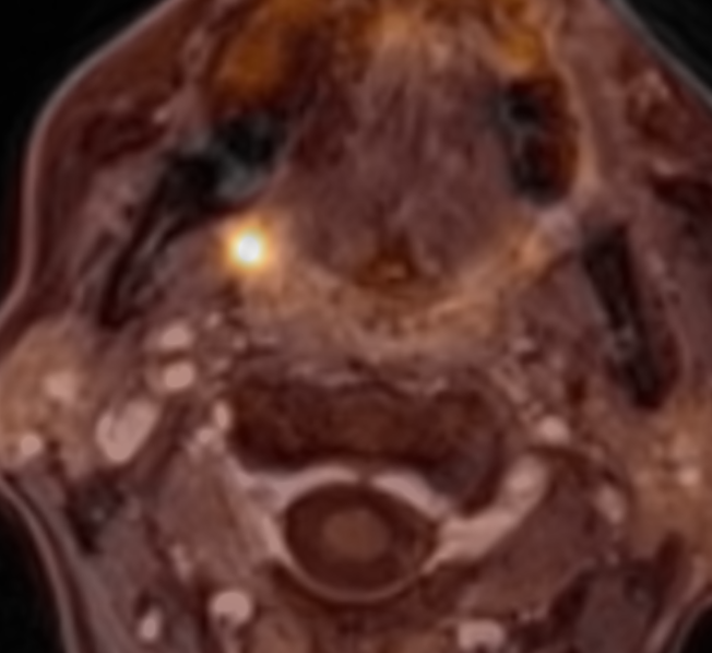 Combined PET/MRI: why use it? A quick case showing one of many benefits from <a href="/jhostetter/">Jason</a> 

👉 youtube.com/watch?v=mMC0XS…

#FOAMed #FOAMrad #radres #neurorad #radiology