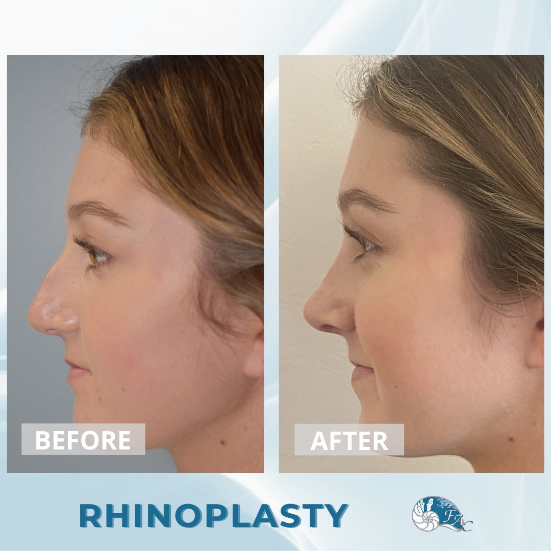 FACOrangeCounty's tweet photo. 'This wonderful patient had to head off to college after her #rhinoplasty! Shes about 4 months out from surgery, and she’s thrilled with her results.  I couldn’t be happier for her!!!"
-
📱 Call today to schedule your rhinoplasty consultation and get a FREE MORPH (888) 502 1150. https://t.co/qWj6tjdcH9