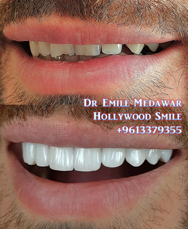 veneerlebanon's tweet photo. #UltraThinVeneers
#SmileDesigner #DrEmileMedawar #CosmeticDentist #DentalImplants #Surgeon #OralSurgery #Specialist #Lebanon #Beirut #SinElFil 961 3 379355.
#PorcelainVeneers #CompositeVeneers #AestheticDentistry #Smile #Dentist
emile_medawar@hotmail.com
https://t.co/2zhVGdzk17 https://t.co/kjm2kbzHJt