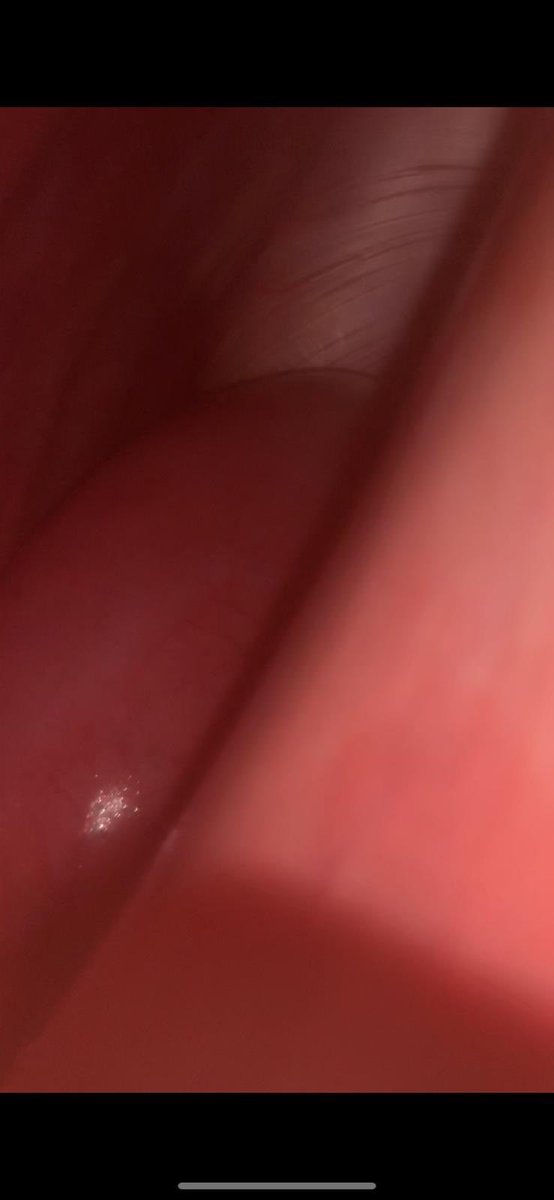 A displaced abomasum caught between the rib cage and rumen