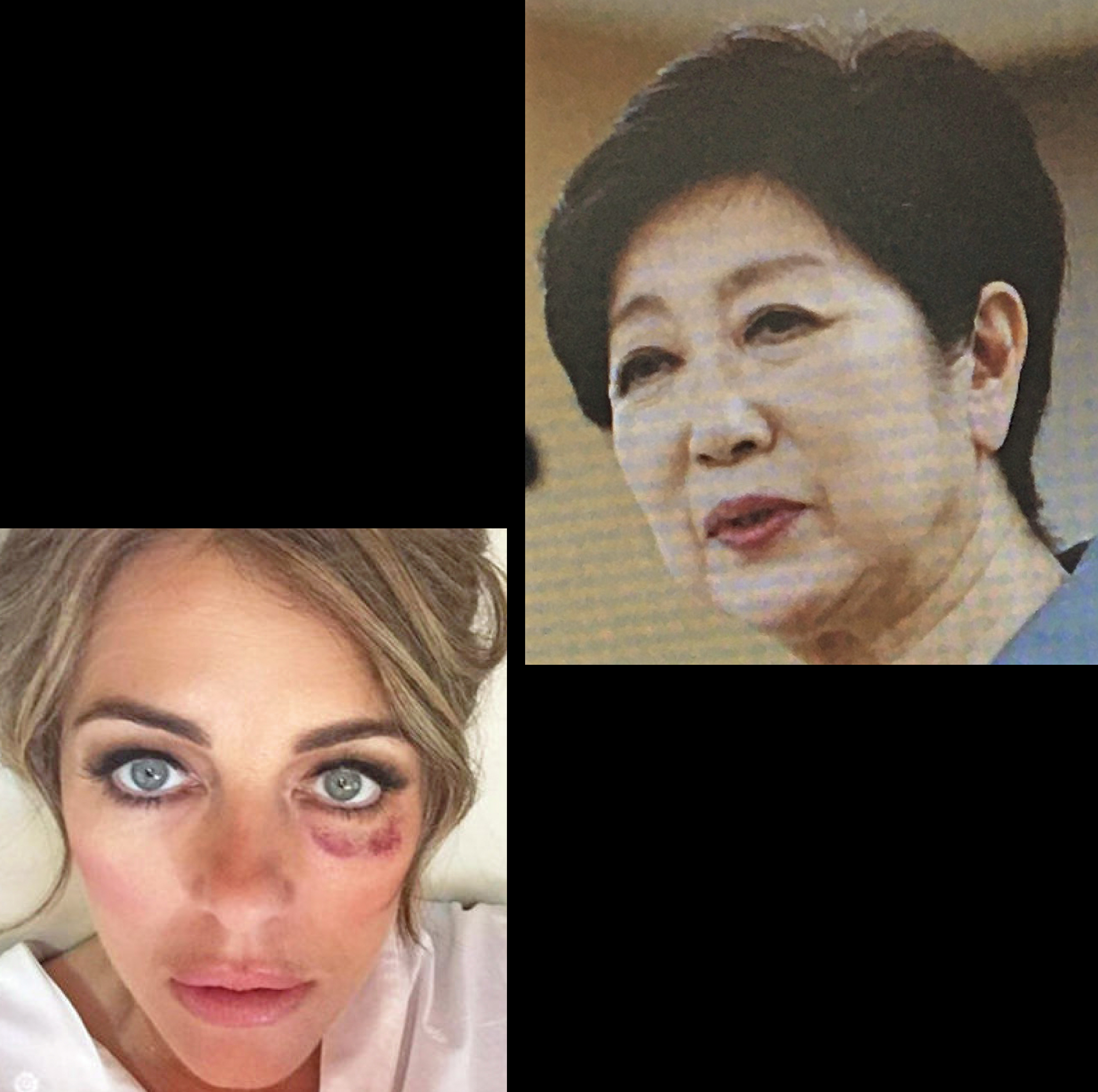 片山徹 英国出身米女優エリザベス ハーレーのアドレノクロム禍による目 の周りの異変にファンはショック 同様に小池百合子東京都知事の目の周りにも異変 アドレノクロム禍か 化粧で消しきれないアザの痕跡 緑の狸の様に見える 前回投稿時よりさらに酷く