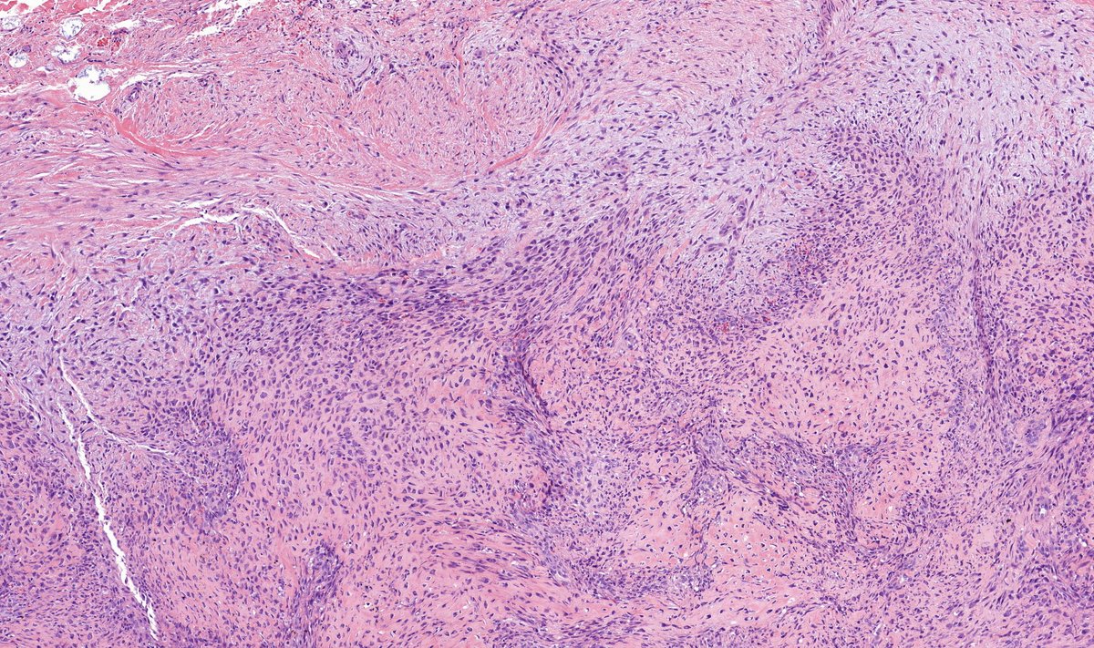 TristanRutland7's tweet photo. Finger, adult

#BSTpath #Surgpath #Pathtwitter https://t.co/vfxuOpKY35