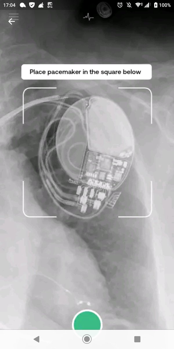 boc66will's tweet image. 胸部レントゲン写真のペースメーカー画像を写真取るだけで各社メーカーを識別出来るというアプリ。

未だに合っていたことはない笑
※画像はサンプルなので個人情報は含まれません