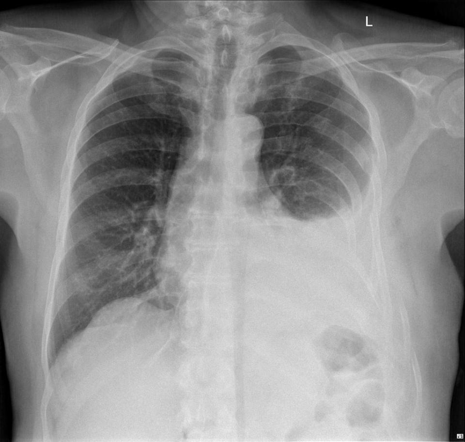 Q: What is the cause of this patient's pleural fluid collection?
ANSWER: goo.gl/AQx3og
#FOAMrad #FOAMed
