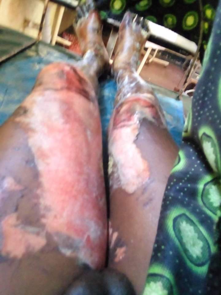 We call on @unhcrkenya to come out and #Airlift our colleagues to Nairobi for proper treatment. Kakuma has no proper medical team to handle these two fire burnt victims. <a href="/jass4justice/">JASS - Just Associates</a> <a href="/MaryLawlorhrds/">Mary Lawlor UN Special Rapporteur HRDs</a> <a href="/MillionWomen/">Million Women Rise</a> <a href="/filia/">DenyseFiliatreault</a> <a href="/UNRefugeeAgency/">USA for UNHCR</a> <a href="/UN_HRC/">UN Human Rights Council</a> <a href="/USEmbassyKenya/">U.S. Embassy Nairobi</a>