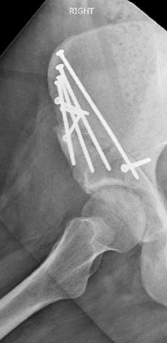 CerisDraws's tweet photo. @whiskeyyoodles (2/2) They ended up doing a surgery on my called a periacetabular osteotomy (PAO). It has VASTLY improved the quality of my life! Plus I set off metal detectors now lol https://t.co/npbFYXvVxd
