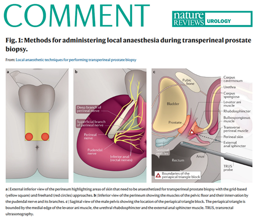 NatRevUrol's tweet photo. #NEWinNRU in this Comment the authors discuss local anaesthetic techniques for performing transperineal prostate biopsy @michael_gorin @EdwardSchaeffer @ashleyrossmdphd @jimhumd @allaway_matthew https://t.co/wosdLEojMP https://t.co/gZDFnh2Yjz