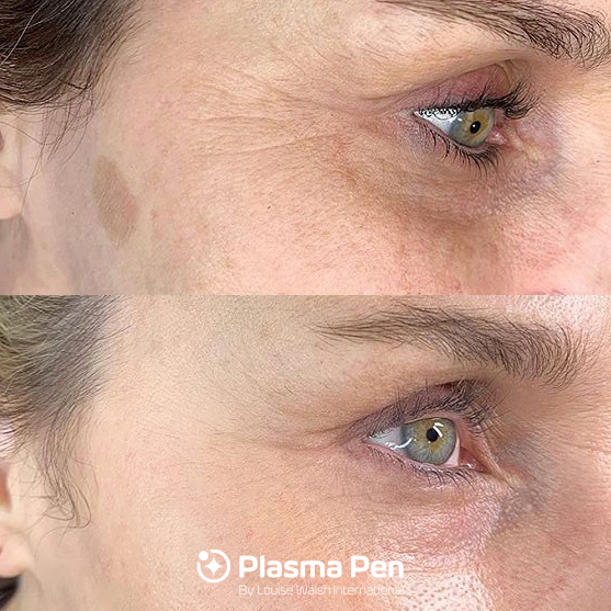 PlasmaPen by Louise Walsh International tweet media