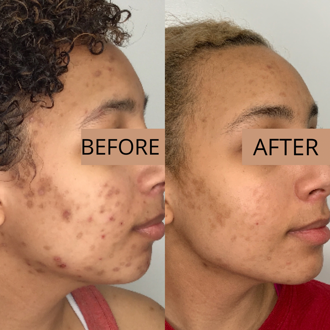 Chemical Peel Before & After