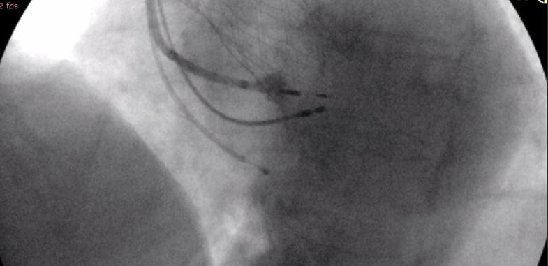 First experiences with the deflectable sheath Medtronic 304 His. In our opinion, it improves the results in LBB pacing, facilitating penetration of the septum, especially in cases of AV block post TAVI such as the one shown and provides more estability for His bundle fixation