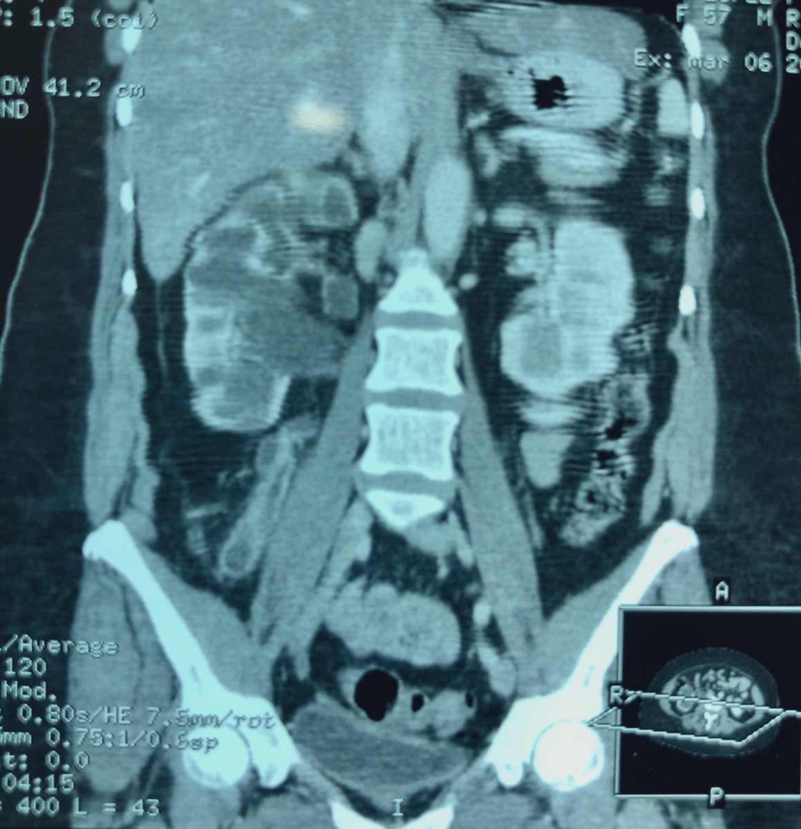 urovictore's tweet photo. Mujer 57 años de edad. 
Nefrectomía laparoscópica en paciente obeso con exclusión renal funcional derecha, posterior a Histerectomía y ligadura ureteral.

#urology https://t.co/i0wzDVhI4Z