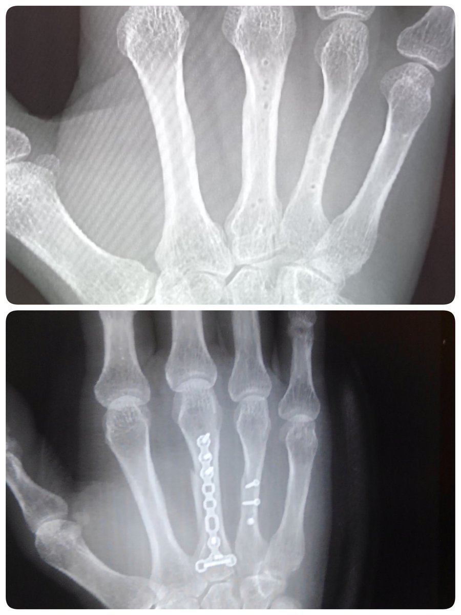 のんち 中手骨骨折 抜釘 今日で診察も終了 約一年かかりました 抜釘手術後初めてのレントゲン プレートとネジを外したところ まだ穴空いとる