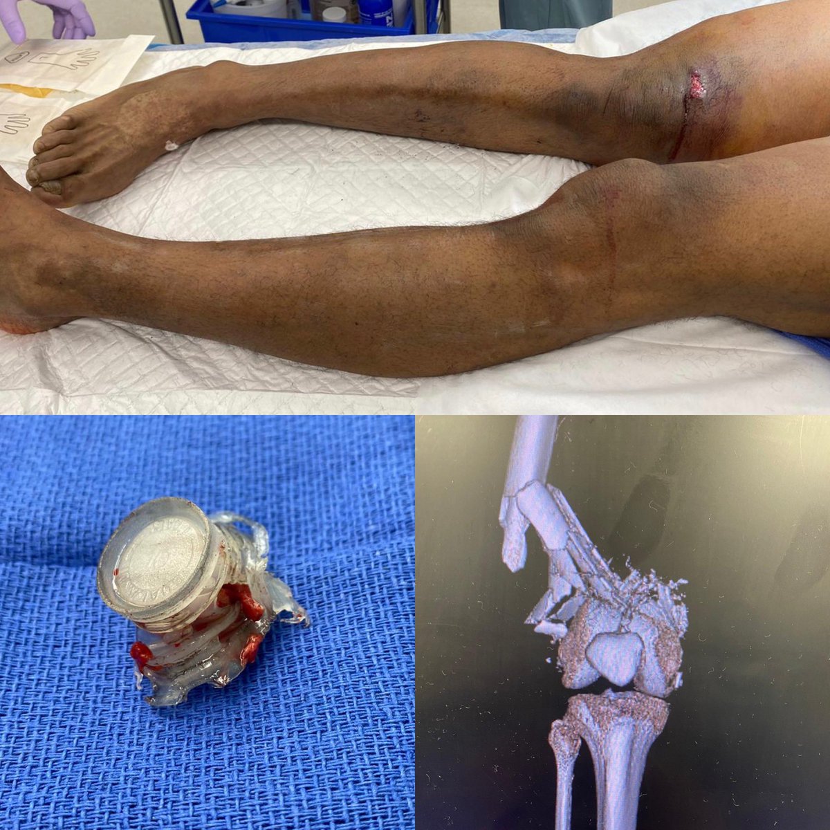 limbsalvagedr's tweet photo. Close range buck shot, transferred from OSH 4 hrs post injury.  Initial SBP 100, - doppler sig, x-ray below.  no motor, min sensation, CTA w/ AT runoff #popsaveit score = 4 (high risk) WWYD? #callvascular @gregamagee @lgmdvascular @elinaq @amilaratnayake @nnainej @ProleneQueen https://t.co/cf5v07ZjHQ