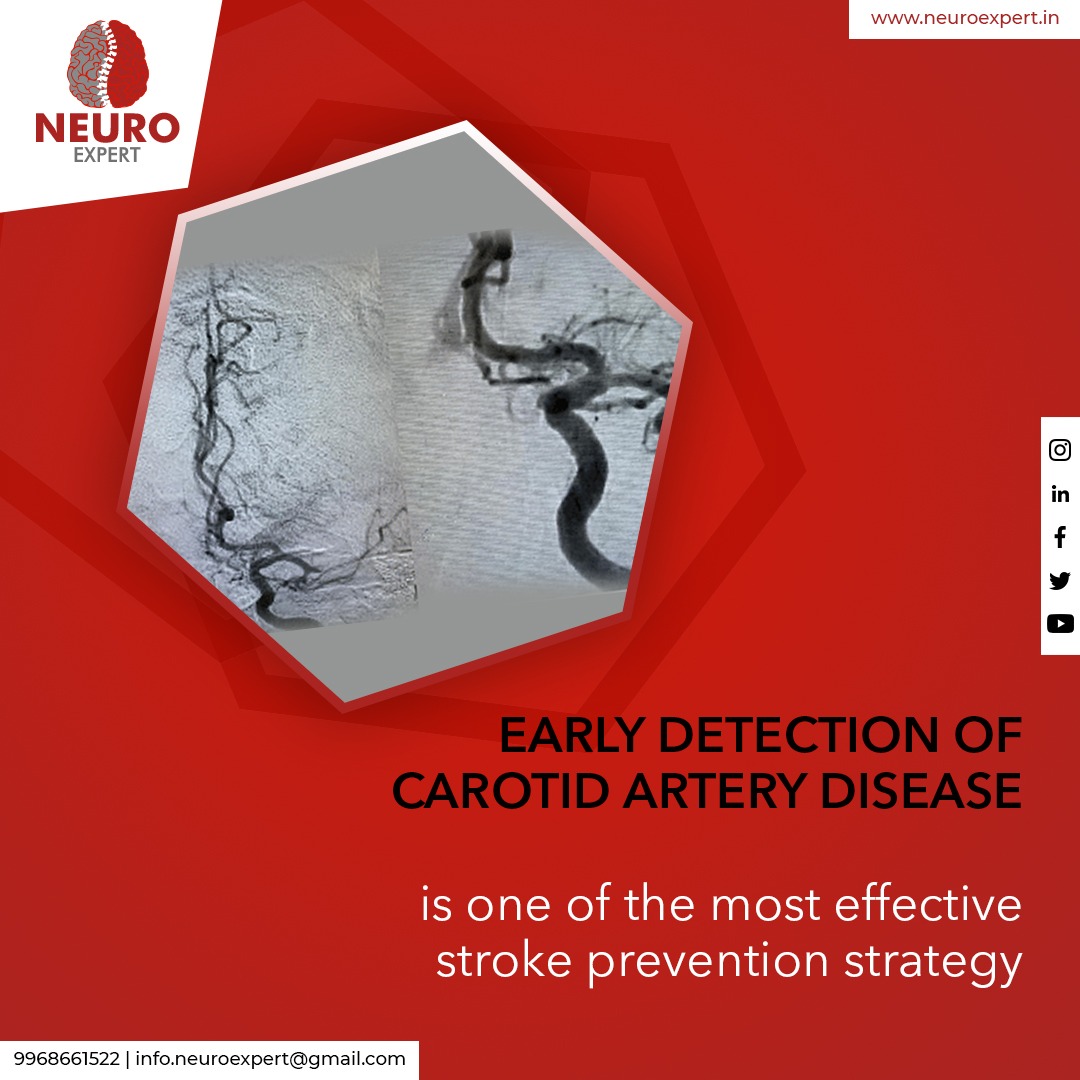 Early detection of Carotid Artery Disease is one of the most effective stroke prevention strategy.

#drvikasguptaneurosurgeon #drvgns #neurosurgery #neurosurgeon #surgery #medicine #neurology #spine #spinesurgery #neuroscience #Medical #CarotidArteryDisease #doctor #treatment