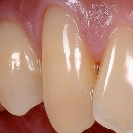 drflossa's tweet photo. These are the adverse effects of using a hard tooth toothbrush and also brushing aggressively.
• Solution; Consult, fill the sensitive pores or look at other options.
#colgatesmile #drfloss https://t.co/4bo0NlxI7d