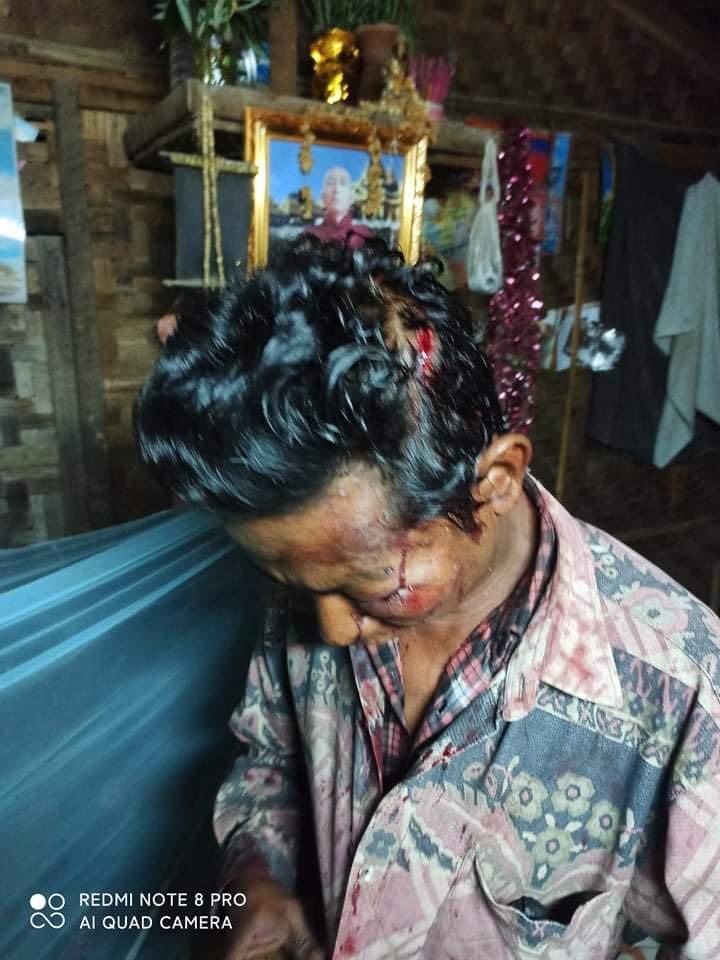 Nyunt-U, Mandalay — Aung Zeya Ward at 12:45am

Terrorists (#Myanmar security forces) hit his face with a gun and stepped on his face with boots. He can’t open his eyes now. 

#WhatsHappeningInMyanmar 
#Mar17Coup 
#MilkTeaAlliance