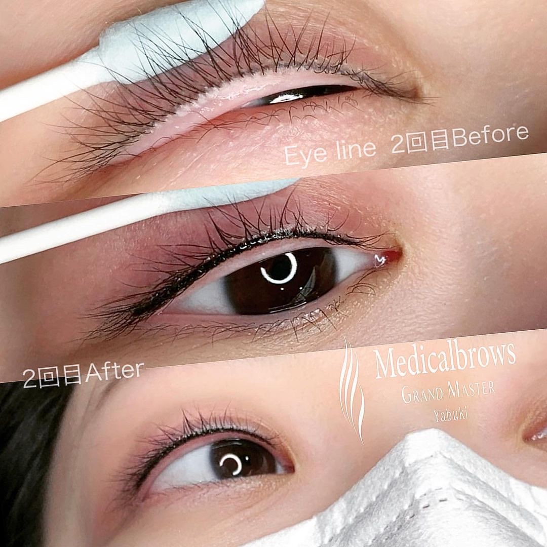 公式 メディカルブロー Medicalbrows アートメイク アイラインアートメイク 上下 まつ毛の間を埋める感じで細いラインで入れています ダウンタイムでは翌日が1番腫れると言われていますが個人差がございます ご参考にしてみてください 公式 メディカルブロー Medicalbrows アートメイク アイラインアートメイク 上下 まつ毛の間を埋める感じで細いラインで入れています ダウンタイムでは翌日が1番腫れると言われていますが個人差がございます ご参考にしてみてください