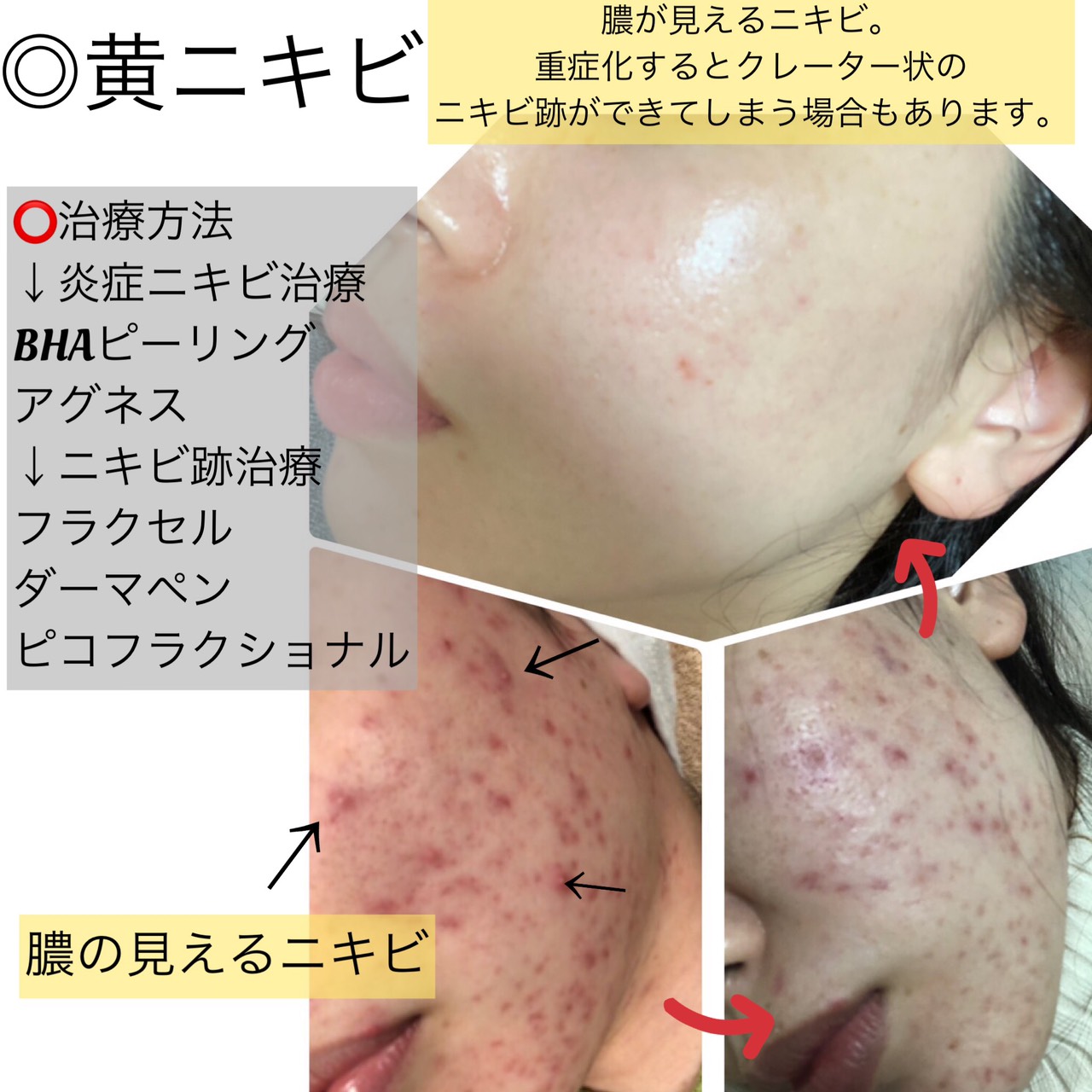 オラクル美容皮膚科 ニキビが繰り返しできる なかなか治らない マスクで悪化した ニキビには種類があり それぞれ原因が違います ニキビの種類別に治療方法例を紹介します ニキビ ニキビ跡についてはこちら T Co