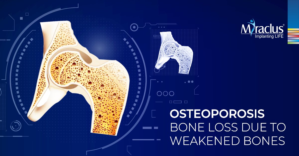 MiraclusOrtho's tweet photo. What is Osteoporosis?
Osteoporosis is a condition of fragile bones with an increased susceptibility to fracture.
#Miraclus #orthopedicsurgeon #orthopedicsolution #wewdnesday #wednesdaythought #osteoporosis #osteoporosisprevention #osteoporosisawareness https://t.co/uXhYSWPmzr