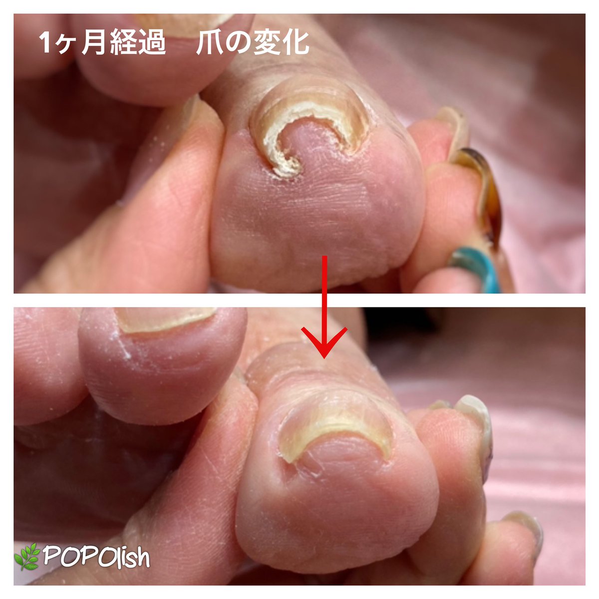 ネイルサロンpopolish 爪の悩み 爪の痛み 解放 足の違和感 爪 水虫 ネイルサロンpopolish 爪の悩み 爪の痛み 解放 足の違和感 爪 水虫