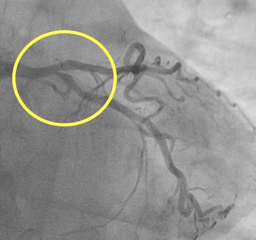 How to treat this ostial LCX lesion in a young patient? We will discuss together!!! #PCI, #DES, #bifurcation.