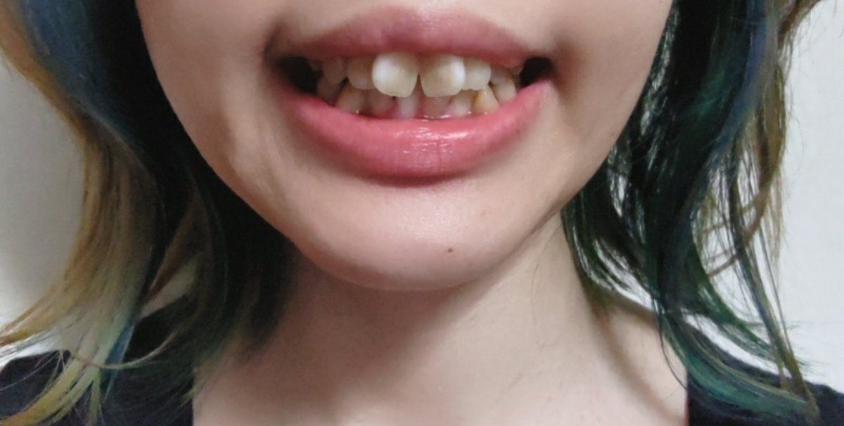 Dep子 6月からフリーター Twitter પર 出っ歯だけど何 歯並びガタガタだと一気にブス とか言う人いるけどそれは 歯並びさえ直せば 美人に見える ぐらいの目鼻立ちの持ち主のみ 元々の顔がブスなら歯並び直しただけじゃ 歯並び は 良いブス になるだけ 出っ歯