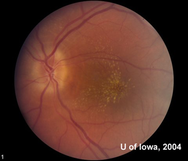 What's the most likely diagnosis for unilateral vision loss + findings below in an otherwise healthy patient?

Full Q/A here 👉 lensophthalmology.com/question-of-th…

Thanks to <a href="/uiowaeye/">UIowa Eye</a> <a href="/EyeRounds/">EyeRounds</a> and <a href="/aao_ophth/">AAO</a> EyeWiki as sources. Special shoutout to <a href="/macularstar/">Janice Law (she/her/s)</a> for your namesake 🌟!