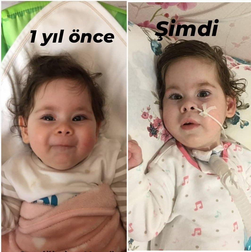 zeynepinciSMA's tweet photo. Zeynep Inci bu hastalık yüzünden 1 yılda birçok şeyini kaybetti.
Aldiği nefesi bile artık hortumlarla mümkün.
Hepinizin desteğiyle hayata tutunması mümkün
Lütfen bağış yapın, paylaşın 
Evladımız yaşasın

#GergerlioğluYalnızDeğildir #MeclisteTeröristİstemiyoruz #RacismIsNotComedy https://t.co/ZyAEX9C4nu