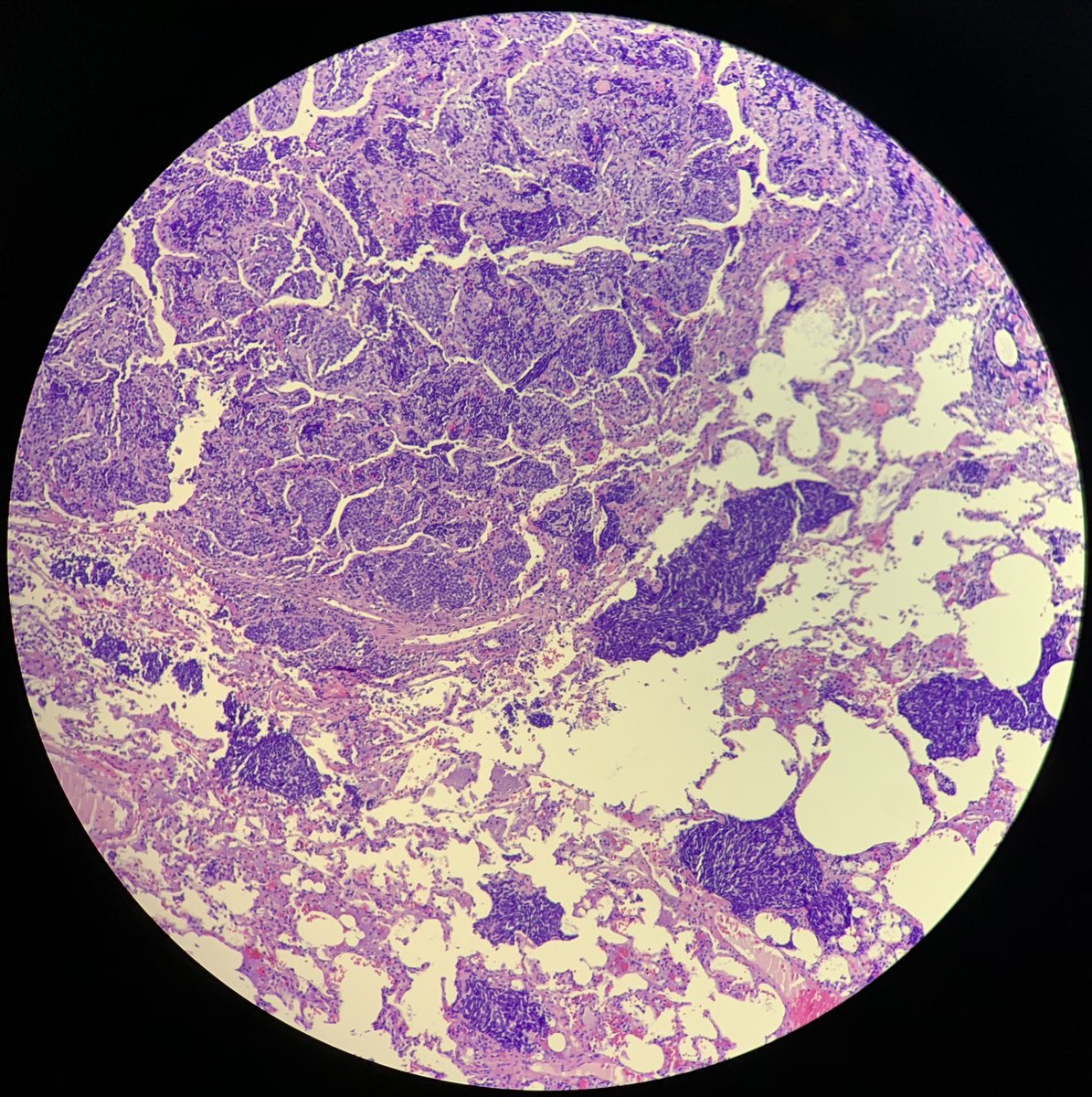 JuliaSrtt's tweet photo. 8 yo girl. 3 mm lung nodule. What’s your diagnosis? #lungpath #pathology #pathologyresident #anatomíapatológica https://t.co/qeCb3kuiEf