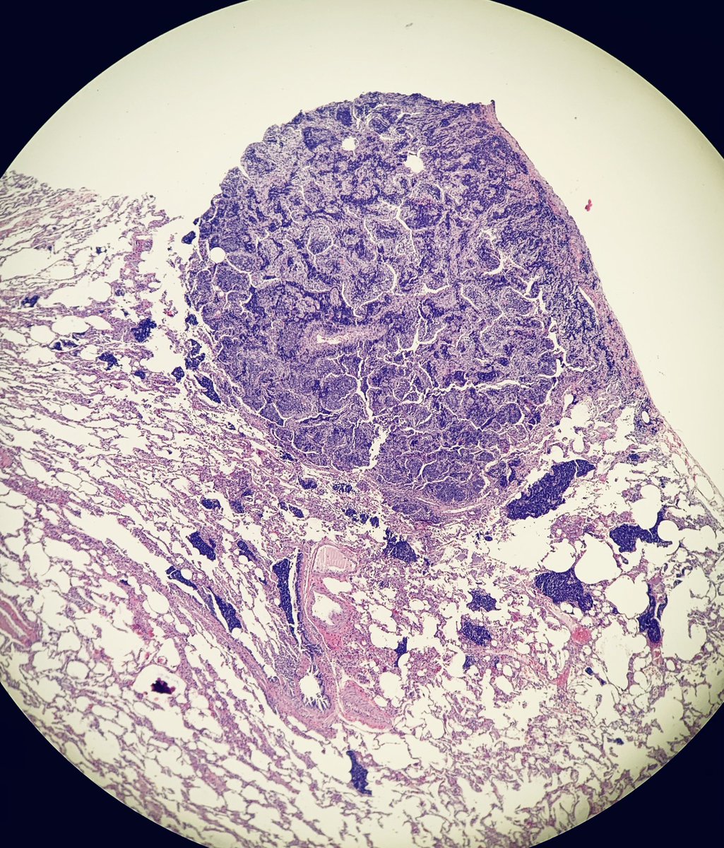JuliaSrtt's tweet photo. 8 yo girl. 3 mm lung nodule. What’s your diagnosis? #lungpath #pathology #pathologyresident #anatomíapatológica https://t.co/qeCb3kuiEf
