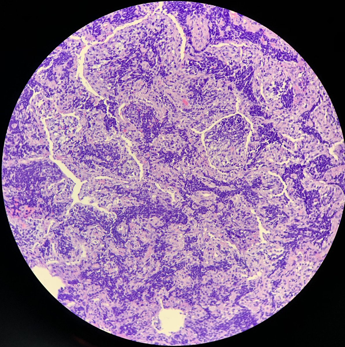JuliaSrtt's tweet photo. 8 yo girl. 3 mm lung nodule. What’s your diagnosis? #lungpath #pathology #pathologyresident #anatomíapatológica https://t.co/qeCb3kuiEf