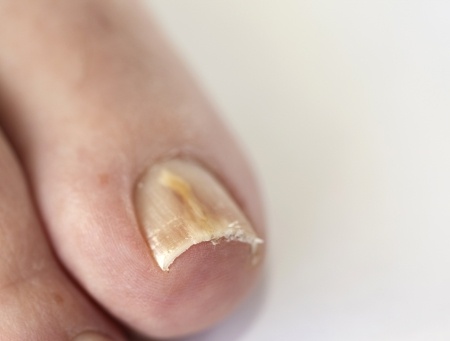 JamesRickettiDP's tweet photo. 3 Causes of Recurrent Toenail Fungus  https://t.co/K0UvciwzyK #ToenailFungus #FungalInfection https://t.co/cTMaRcaJrs