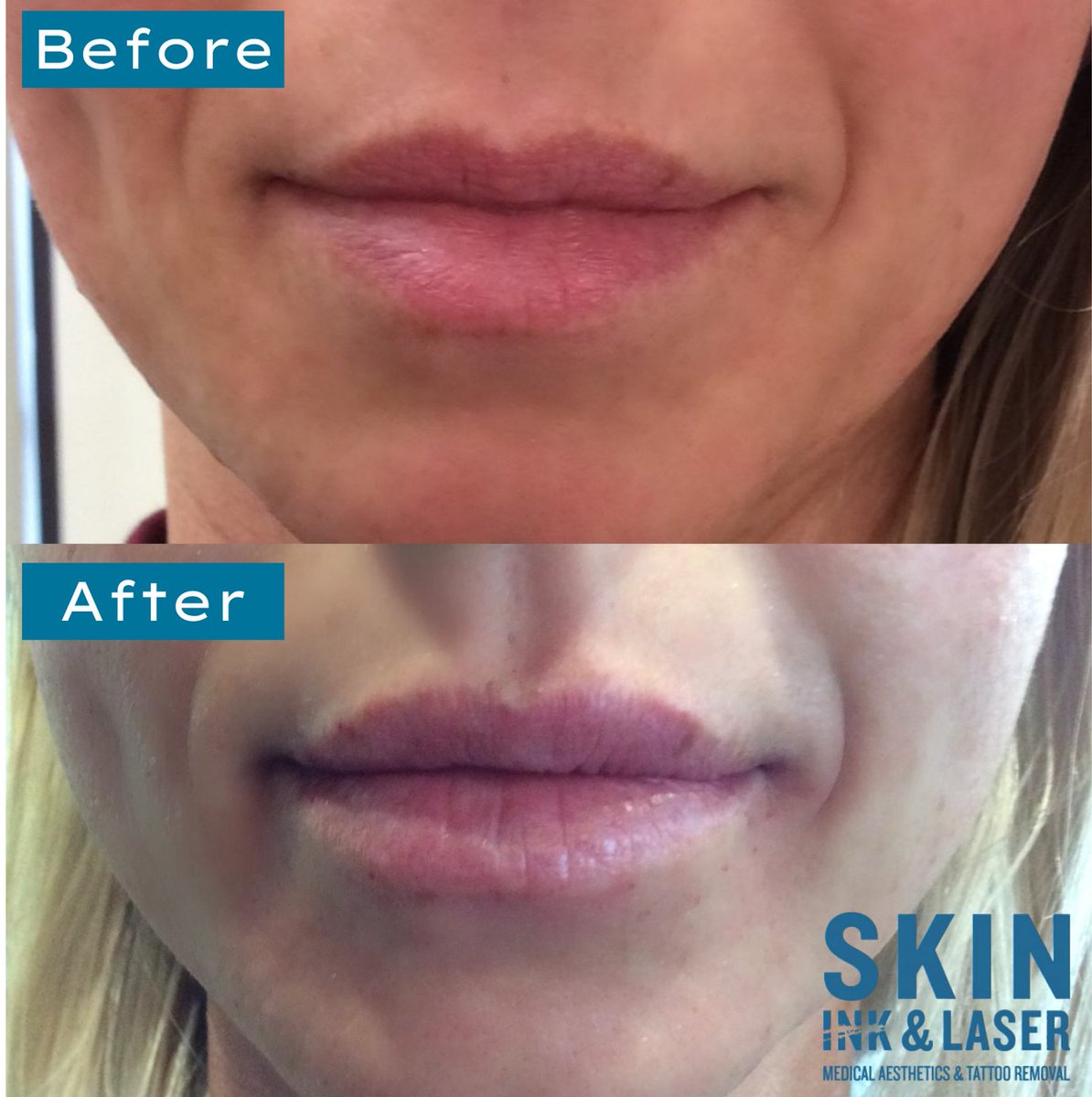 skininklaser's tweet photo. Look at that symmetry! If you’re dreaming of volume, or just more proportional lips, Juvéderm Ultra XC is the perfect filler for you!💋 https://t.co/if7EdB6plY