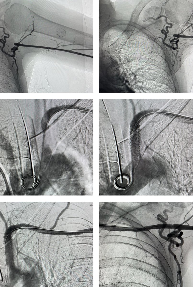 vascularwednes's tweet photo. CTO of the left subclavian artery - recanalization using Ballon angioplasty and covered stent 8x32mm

#vascularwednesday #cto  #irad #coveredstent https://t.co/2wf3qgwWZ6