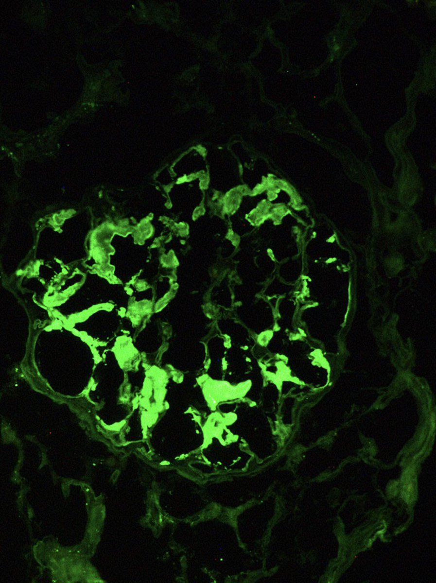NephroPath's tweet photo. Happy St Patrick’s day! Spot diagnosis and good luck everyone ���� #renalpath #pathology #kidneypathology #nephrology #picoftheday #saintpatricksday https://t.co/6RuLQb8irO