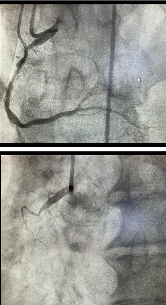 RohanKalMD's tweet image. What just 5 months of continued smoking can do the the coronaries. Middle aged man with LAD STEMI at outside facility, presents now for completion RCA PCI, which is now occluded. Treated with #RadialFirst #imageguided 4.0/3.0/2.5 stents #cardiotwitter