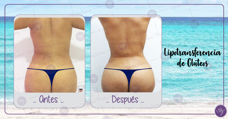 bellaforma_peru's tweet photo. ¡RESULTADOS GARANTIZADOS! 
Te mostramos el cambio de algunas de nuestras pacientes.
👉Las imágenes mostradas son fotos reales y no han sido sometidas a ningún tipo de retoque o edición. 

Solicita  tu cita gratuita https://t.co/71IKcJ2SF8 https://t.co/PLlDJGrneP