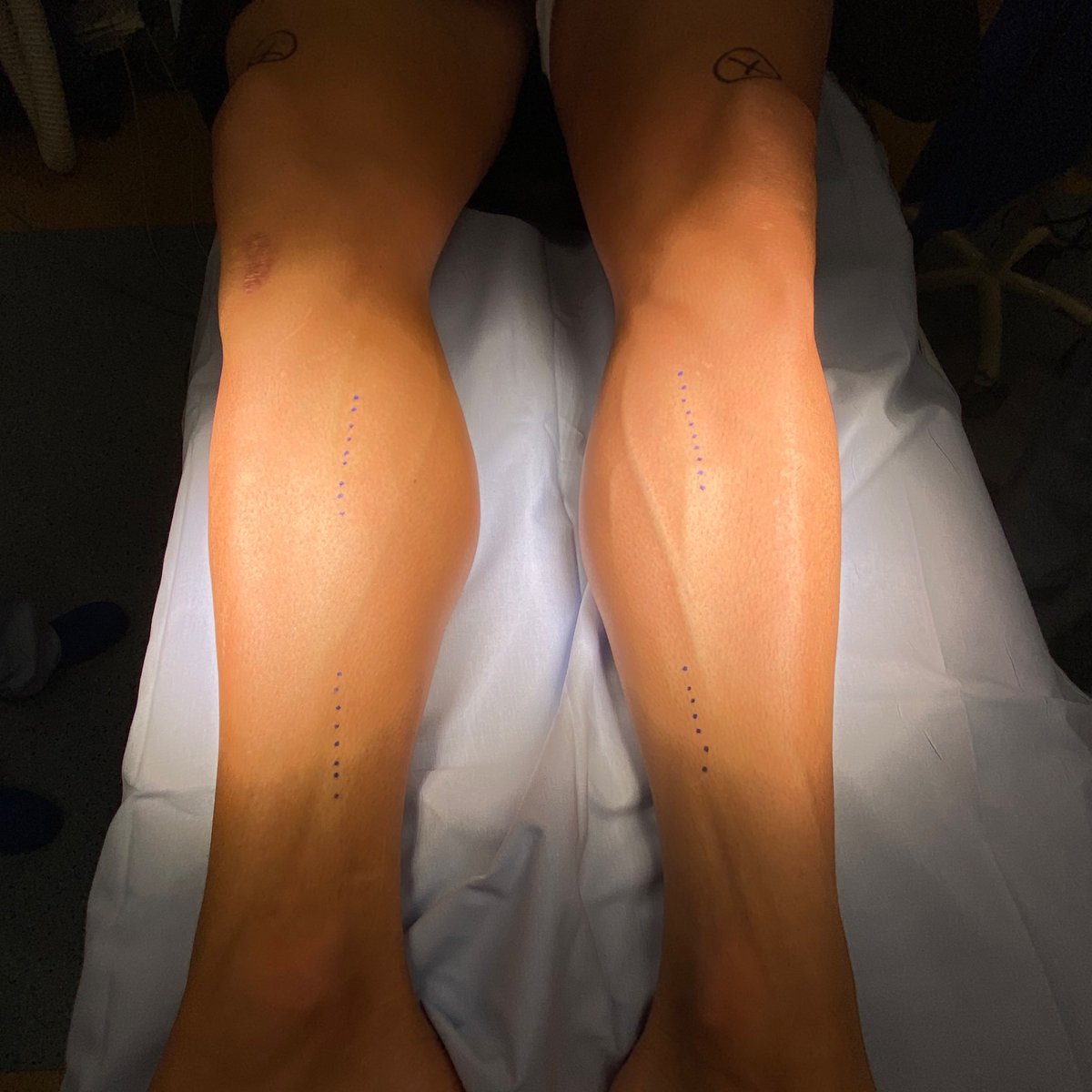 El atleta olímpico (Rio 2016) Daniel <a href="/AndujarCET/">Daniel Andujar Ponce</a> ha sido intervenido de síndrome compartimental crónico del ejercicio bilateral (compartimentos posteriores de ambas piernas), realizándose fasciotomia bilateral y es dado de alta en <a href="/ClinicaCEMTRO/">ClinicaCEMTRO</a> 
Comienza la recuperación hoy