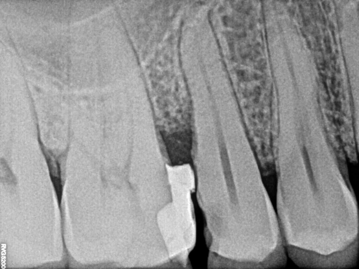 ManiMedicalInd's tweet photo. "I always love to do restorations especially Class II. Only aim of this post is to encourage fellow dentists for restorations rather to jump for RCTs.
Thankyou Mani India for wonderful products #ManiBond #manimicro #manibulk
Dr. Sukhwant Singh Yadav, Endodontist" https://t.co/MG5GFPySYs