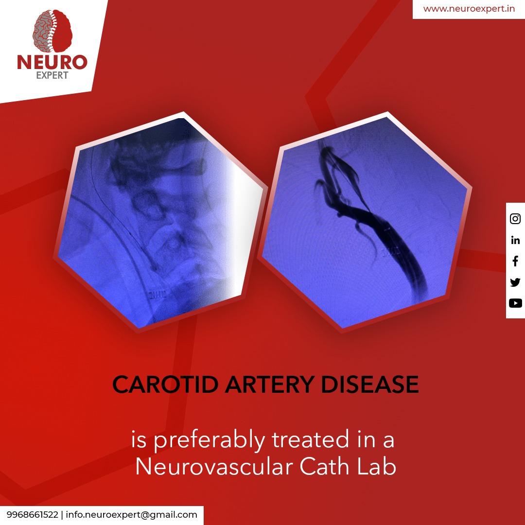 Carotid Artery Disease is preferably treated in a Neurovascular Cath Lab

#drvikasguptaneurosurgeon #drvgns #neurosurgery #neurosurgeon #surgery #medicine #neurology #spine #spinesurgery #neuroscience #Medical #CarotidArteryDisease #doctor #treatment