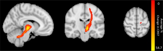 Lead-DBS (@leaddbs) on Twitter photo Nice study spearheaded by Hannah Riskin-Jones w/ <a href="/AlonKashanian/">Alon Kashanian</a> <a href="/HiroSparks/">Hiro Sparks</a> et al. in <a href="/drpouratian/">Dr Nader Pouratian FCNS</a>'s team showing connectivity to dentate & M1 is associated with tremor suppression.
<a href="/HarithAkram/">Harith Akram</a> <a href="/EMiddlebrooksMD/">Erik Middlebrooks, MD</a> <a href="/Bassam_Al_Fatly/">Bassam Al-Fatly</a>
sciencedirect.com/science/articl… Nice study spearheaded by Hannah Riskin-Jones w/ <a href="/AlonKashanian/">Alon Kashanian</a> <a href="/HiroSparks/">Hiro Sparks</a> et al. in <a href="/drpouratian/">Dr Nader Pouratian FCNS</a>'s team showing connectivity to dentate & M1 is associated with tremor suppression.
<a href="/HarithAkram/">Harith Akram</a> <a href="/EMiddlebrooksMD/">Erik Middlebrooks, MD</a> <a href="/Bassam_Al_Fatly/">Bassam Al-Fatly</a>
sciencedirect.com/science/articl…