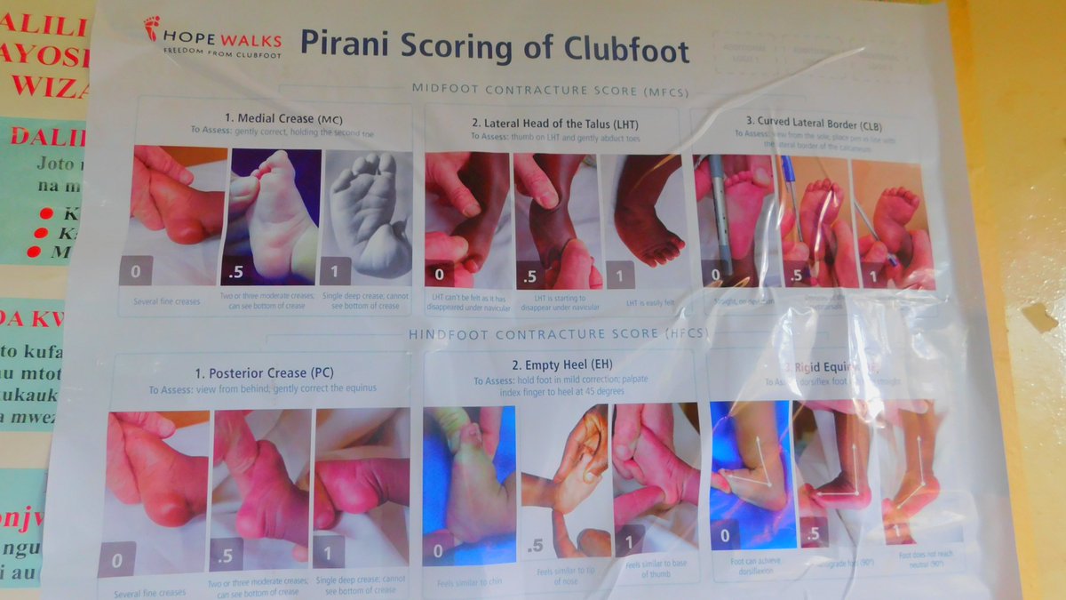 HealthNyeri's tweet photo. Free clubfoot management services are available at Nyeri County Referral Hospital. This noble course has been supported by @hopewalksorg with an aim of successfully rehabilitating clients with club foot to be able to walk normally and evade long-term disabilities
@GovernorKahiga https://t.co/iw6SkbSRlf
