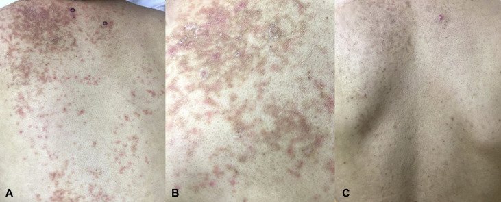 thidakarn's tweet photo. กินคีโต มีผลข้างเคียงหนึ่งที่เกิดได้ในระยะต้นคือ Prurigo pigmentosa หรือ keto rash ลักษณะผื่นคันตามตัว  สันนิษฐานว่าจากคีโตนที่ถูกขับออกมาและการอ��กเสบ แก้ไขโดยกลับมากินแป้ง และแพทย์อาจสั่งยาที่ช่วยลดการอักเสบ 

รูปประกอบจาก https://t.co/tXZCwIV5rc https://t.co/xNj2rcsjSz