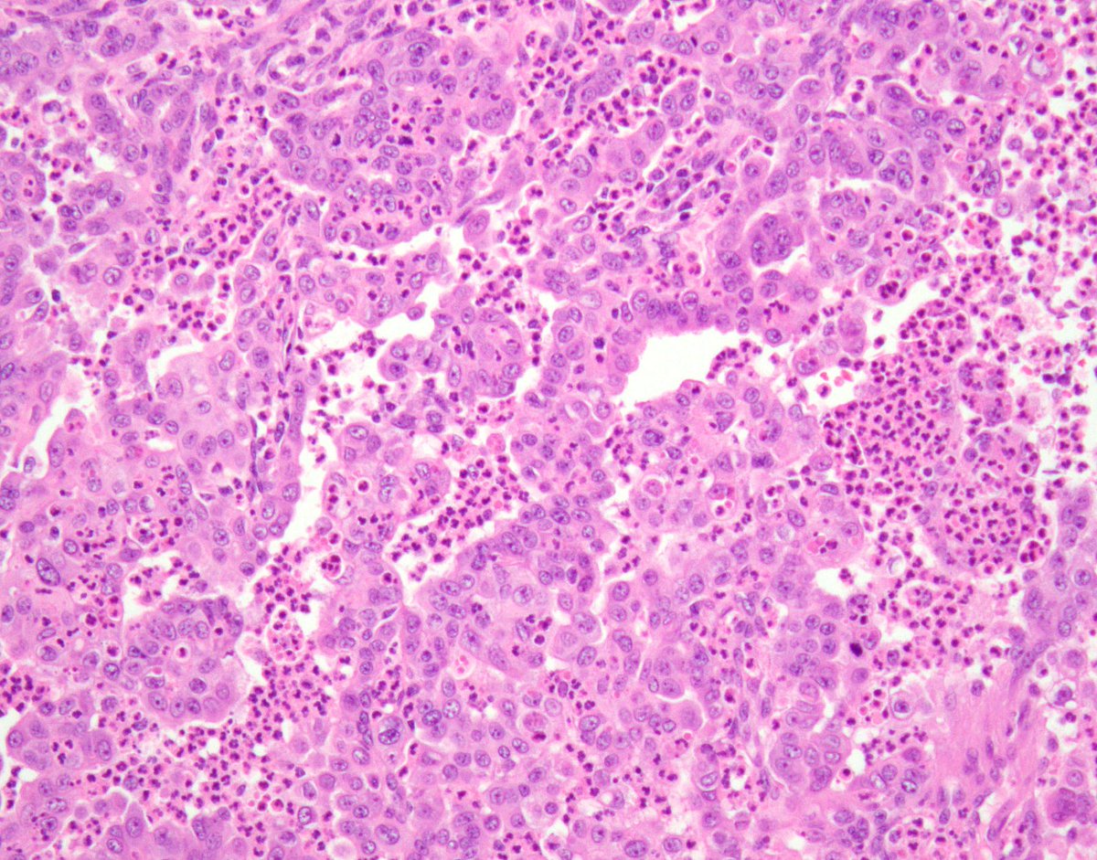 Renal Medullary Carcinoma 1/

Classic Associations:
- Adolescent / young adult w/ Sickle Cell Trait
- Highly infiltrative w/fibromyxoid &amp; desmoplastic stroma 
- Necrosis &amp; 'micro-abscesses'

Clinically, aggressive w/poor outcomes

#gupath #kidneycancer #KidneyCancerAwarenessMonth