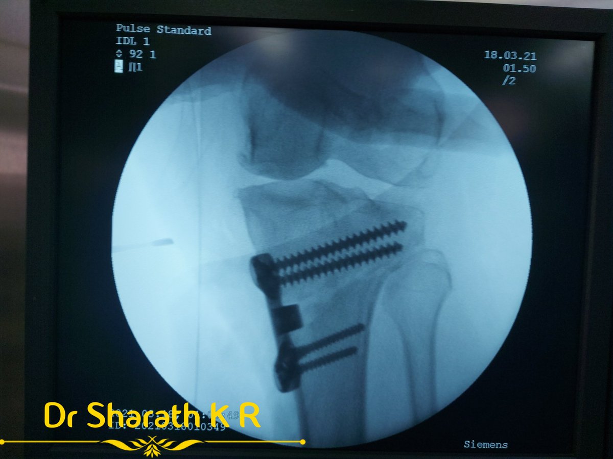 RamanathSharath's tweet photo. Medial open wedge osteotomy with arthtex HTO plate .
#HTO #arthrex #sharathkr #orthosurgery #knee #alignmentcorrection 
#kneepreservingsurgery https://t.co/xJmZmhaiuN